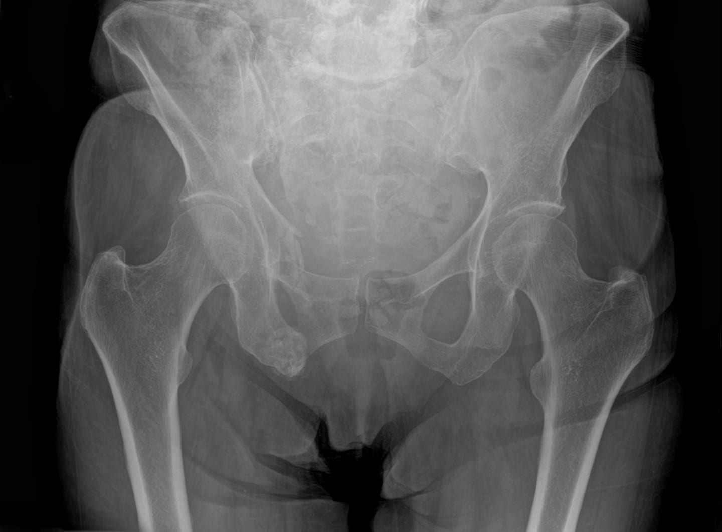 Hip breaks more deadly than some cancers in elderly, study finds