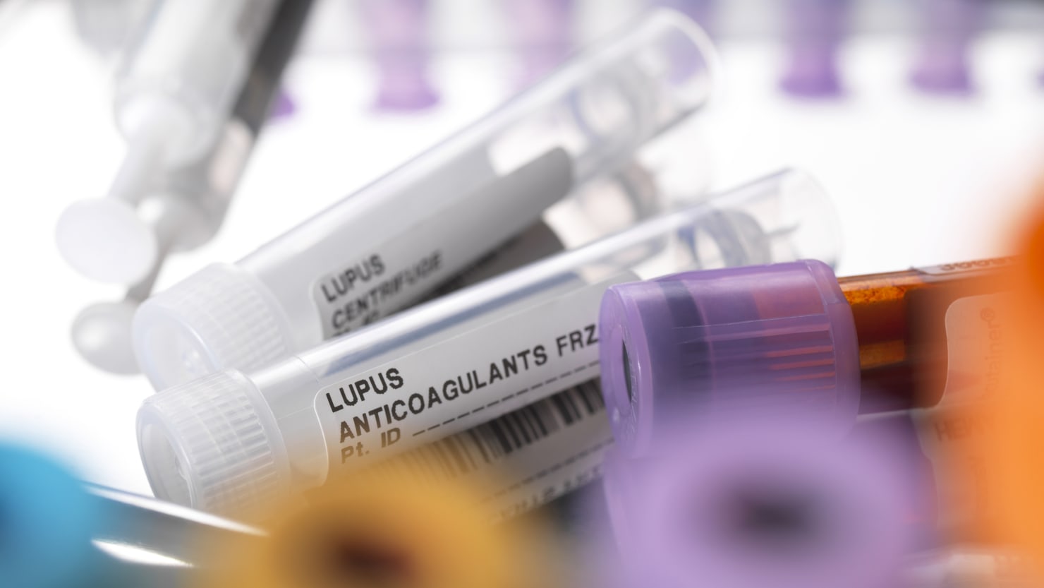 Northwestern University Scientists Discover Potential Lupus Cure